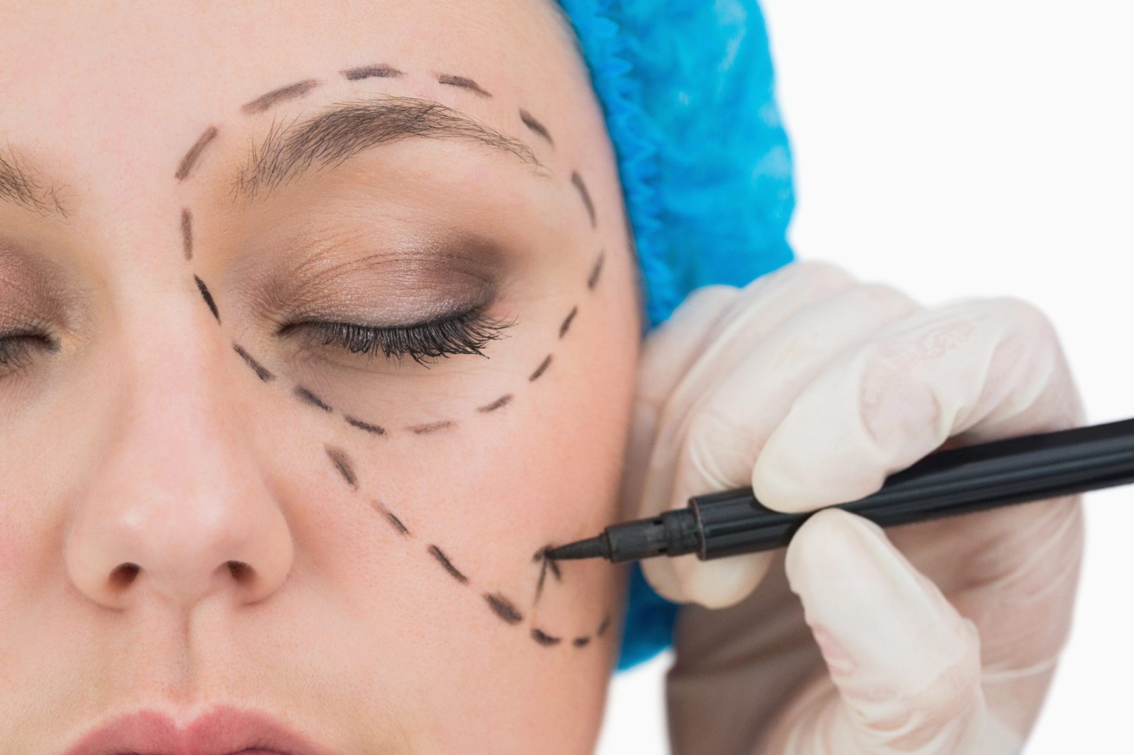 Kirurška metoda facelift za pomlajevanja obraza